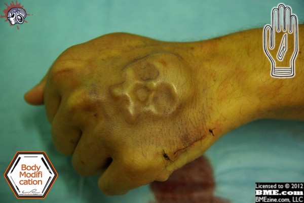 Subdermal implantation is a body modification of putting small shaped objects under the skin to raise the epidermis or skin into distinct patterns